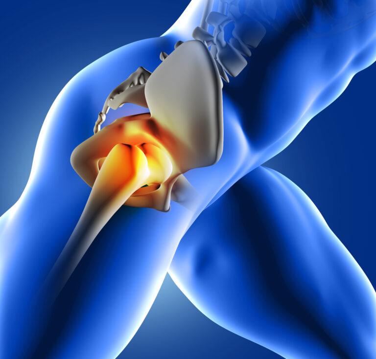 Femoral Acetabular Impingement Syndrome, A Review
